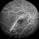 Tilted Disc Syndrome Complicated with RPE Atrophy and Polypoidal Choroidal Vasculopathy Tilted Disc Syndrome Complicated with RPE Atrophy and Polypoidal Choroidal Vasculopathy
