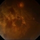 Chorioretinitis Sclopetaria Chorioretinitis Sclopetaria