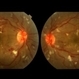 Hypertensive Retinopathy Hypertensive Retinopathy