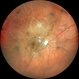 BRVO With Optic Atrophy BRVO With Optic Atrophy