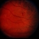 Retinal Capillary Hemangioblastoma Retinal Capillary Hemangioblastoma