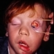Linear Nevus Sebaceous Syndrome Linear Nevus Sebaceous Syndrome