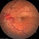 Combined central retinal vein occlusion and branch retinal arteriolar occlusion