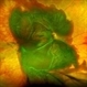 Massive SRH in Patient on Coumadin Being Treated for Exudative AMD