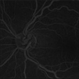 HTN Retinopathy with Pre-Papillary Vascular Loop OS HTN Retinopathy with Pre-Papillary Vascular Loop OS