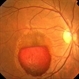 Valsalva Retinopathy Valsalva Retinopathy