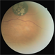 Solitary Congenital Hypertrophy of the Retinal Pigment Epithelium with Lacunae Solitary Congenital Hypertrophy of the Retinal Pigment Epithelium with Lacunae