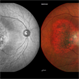 Choroidal Hemangioma Choroidal Hemangioma