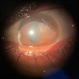Traumatic Iris Cyst Traumatic Iris Cyst