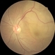 Retinal Detachment Retinal Detachment
