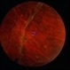 Angioma from Chronic Retinal Detachment Angioma from Chronic Retinal Detachment