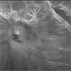 Total Rhegmatogenous retinal detachment with opened posterior margin of lattice degeneration Total Rhegmatogenous retinal detachment with opened posterior margin of lattice degeneration