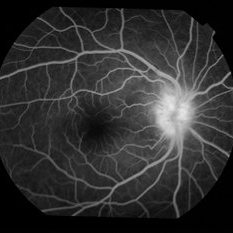 Neuroretinitis - Retina Image Bank