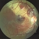 Berlin's Edema With Hemmorrhagic PED