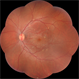 Autosomal Recessive Bestrophinopathy Autosomal Recessive Bestrophinopathy