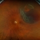 Retinal Detachment with Horseshoe Retinal Tear Retinal Detachment with Horseshoe Retinal Tear
