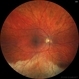 Commotio retinae
