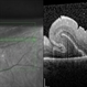 Retinal Fold Retinal Fold