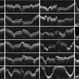North Carolina Macular Dystrophy OCT Collage North Carolina Macular Dystrophy OCT Collage