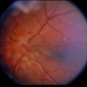 Retinal Capillary Hemangioblastoma Retinal Capillary Hemangioblastoma