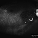 Adenocarcinoma Arising from CHRPE