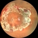360 Degree Retinectomy 360 Degree Retinectomy