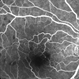 BRVO With Decreased Vision from Ruptured Aneurysm in Area of Collateral Vessels BRVO With Decreased Vision from Ruptured Aneurysm in Area of Collateral Vessels