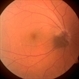 Benign Melanocytoma of the Optic Disc
