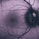 Optic Disc Drusen