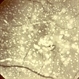 Primary Hyperoxaluria and Oxalosis
