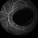 Primary Subhyaloid Hemorrhage Due to Valsalva Retinopathy
