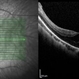 Myopic Traction Maculopathy