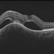 Choroidal Granuloma Secondary to Tuberculosis Choroidal Granuloma Secondary to Tuberculosis