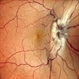 Venolymphatic Mass with Retinal Folds Venolymphatic Mass with Retinal Folds