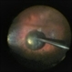 PPV retained cataract PPV retained cataract