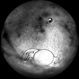 IOL in Vitreous Cavity Right Eye IOL in Vitreous Cavity Right Eye