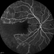 Idiopathic Occlusive Retinal Vasculitis (Late Stage) Idiopathic Occlusive Retinal Vasculitis (Late Stage)