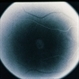 Adult Foveomacular Dystrophy / Pattern Adult Foveomacular Dystrophy / Pattern