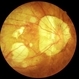 Myopic retinopathy Myopic retinopathy