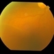 Bilateral Senile Retinoschisis