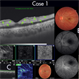 Figure-1 Paracentral Acute Middle Maculopathy (PAMM) Figure-1 Paracentral Acute Middle Maculopathy (PAMM)