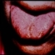 Multiple Endrocrine Neoplasia