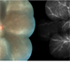 Frosted Branch Angiitis in an Adult Patient with Sympathetic Ophthalmia Frosted Branch Angiitis in an Adult Patient with Sympathetic Ophthalmia