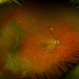 Tractional Retinal Detachment