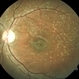 Stargardt's Disease LE Stargardt's Disease LE
