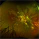 Serpiginous Choroidopathy Serpiginous Choroidopathy