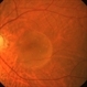 Acquired Optic Pit Maculopathy Acquired Optic Pit Maculopathy