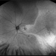 Macula Off Retinal Detachment with CNV Macula Off Retinal Detachment with CNV
