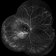 Choroidal Tuberculoma Fluorescence Angiography Montage