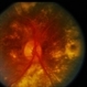 CNVM / Cholesterolemia